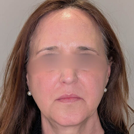 Brow Lift case #5371