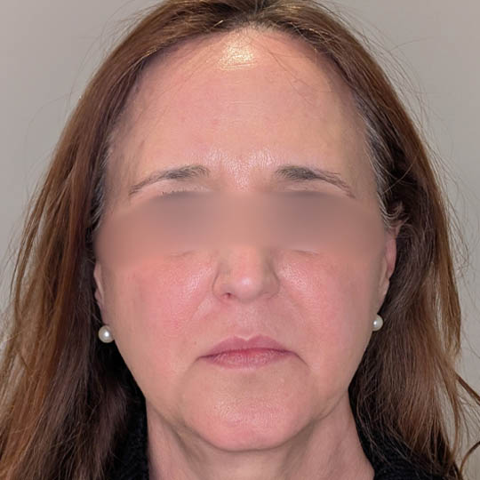 Brow Lift case #5371
