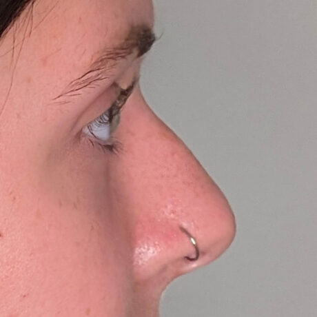 Liquid Rhinoplasty case #5394