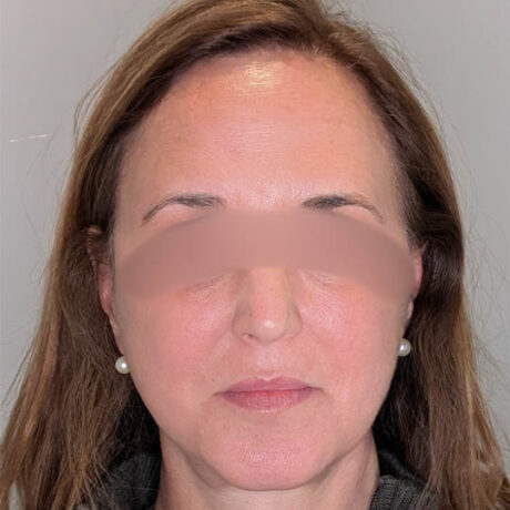 Brow Lift case #5371