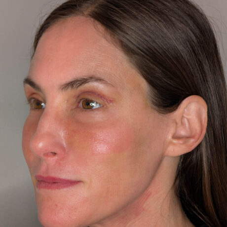 Eyelid Surgery case #5397