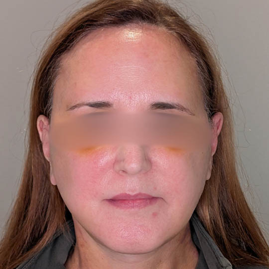 Brow Lift case #5371