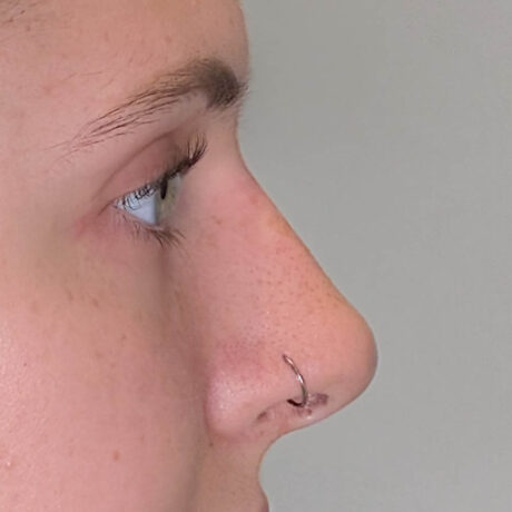 Liquid Rhinoplasty case #5394