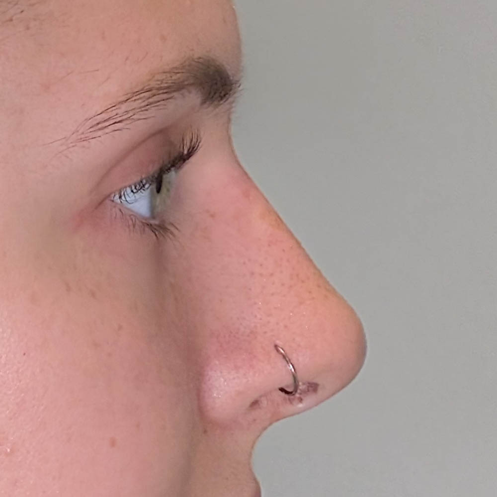 Liquid Rhinoplasty case #5394