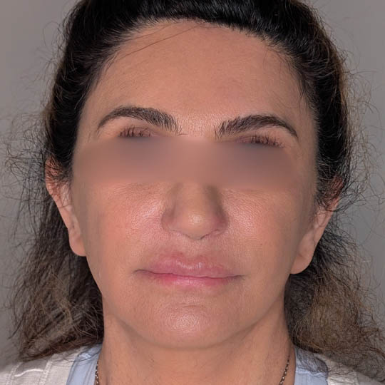 Brow Lift case #5374