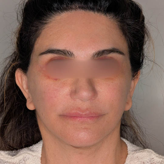 Brow Lift case #5374