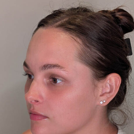 Forehead Reduction case #5378