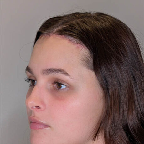 Forehead Reduction case #5378
