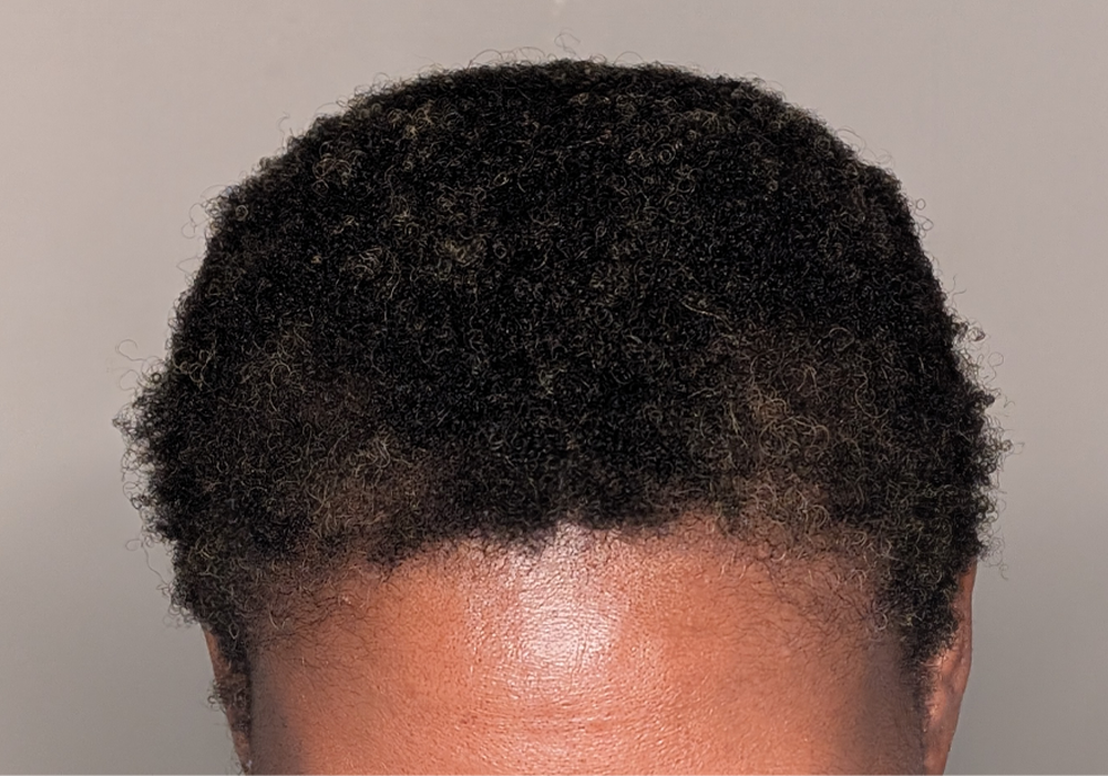 Hair Transplant case #5391