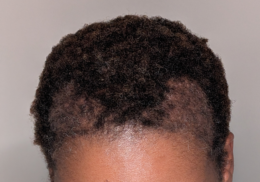 Hair Transplant case #5391