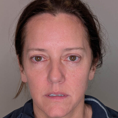 Brow Lift case #5604