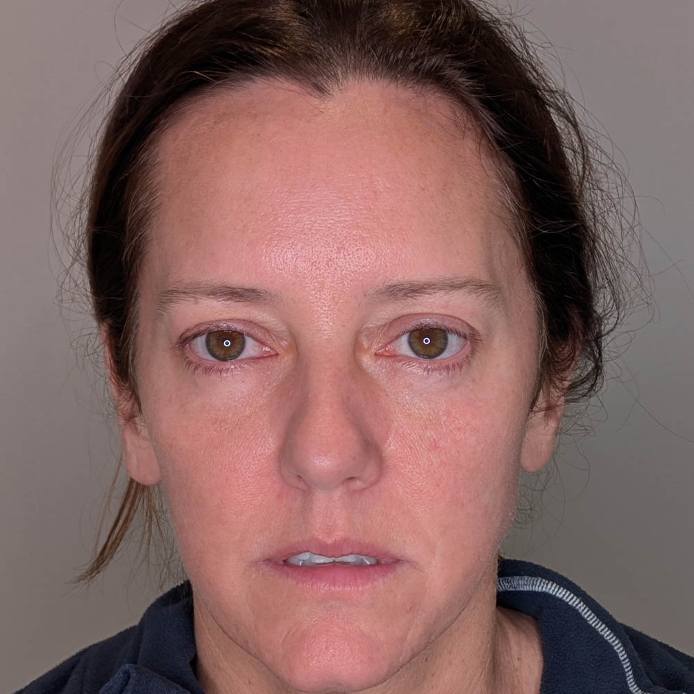 Brow Lift case #5604