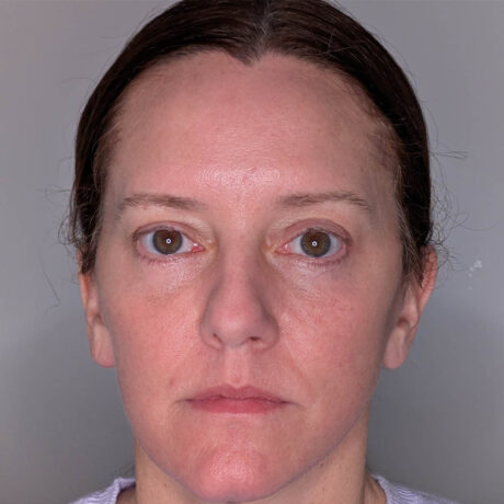 Brow Lift case #5604