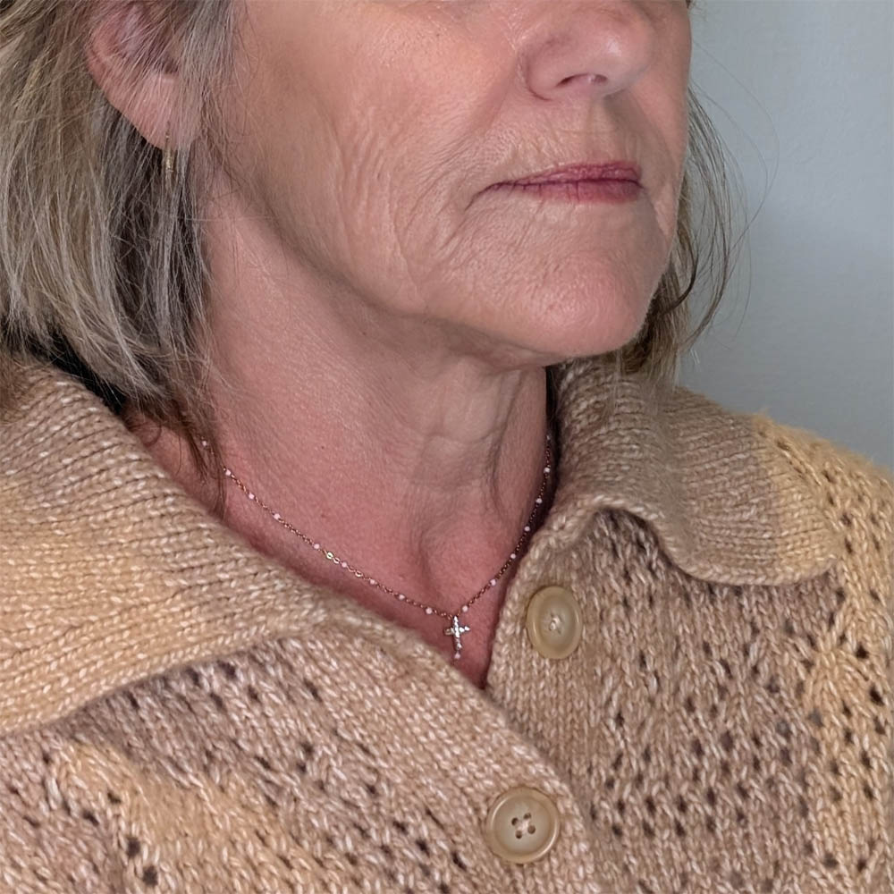 1_0008_Pam M. Before (Facelift, Agg. Laser).jpg