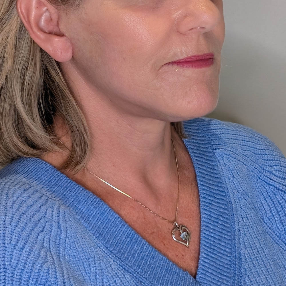 1_0009_Pam After (facelift, Agg. Laser).jpg