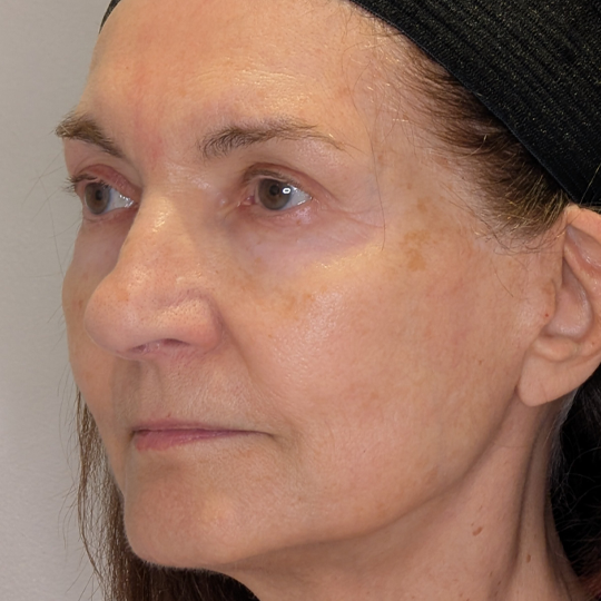 Rhinoplasty case #5639