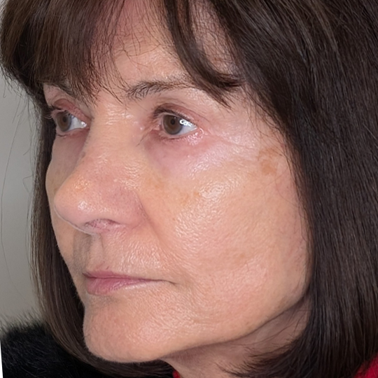 Rhinoplasty case #5639