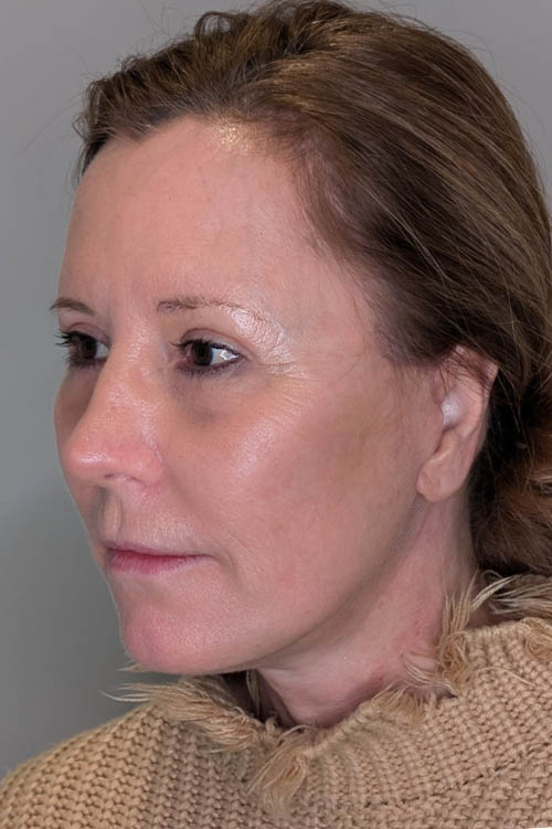 UltraClear case #5633