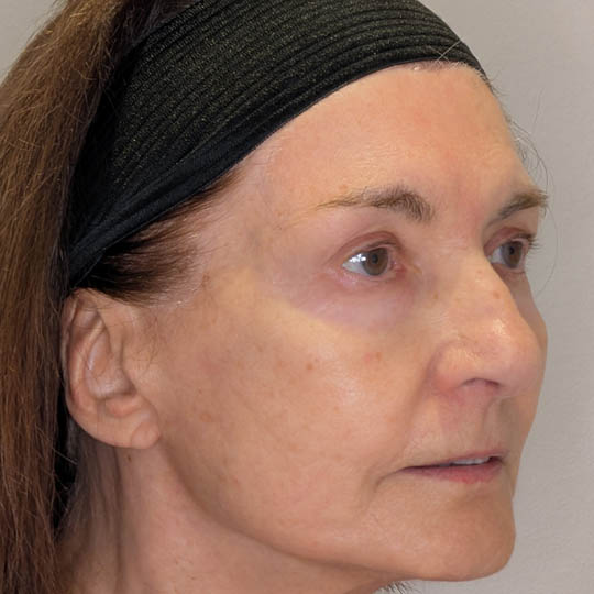 Rhinoplasty case #5639