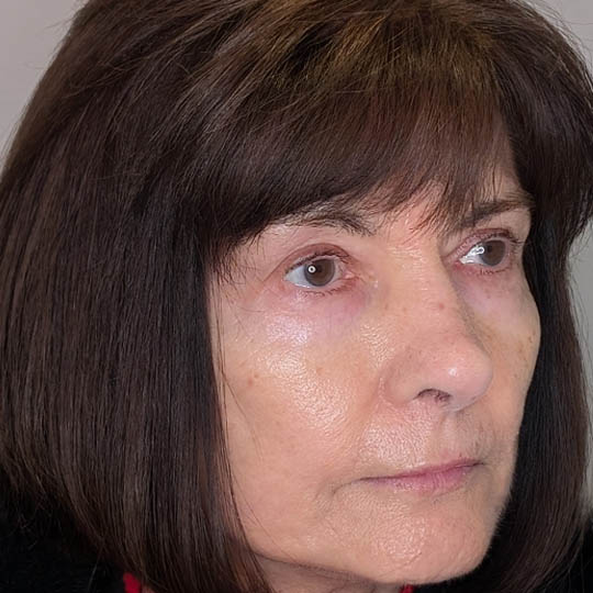 Rhinoplasty case #5639