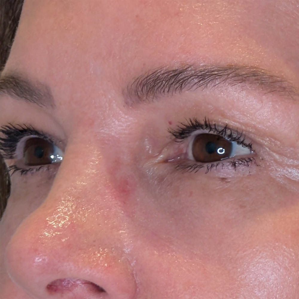 Brow Lift case #5782