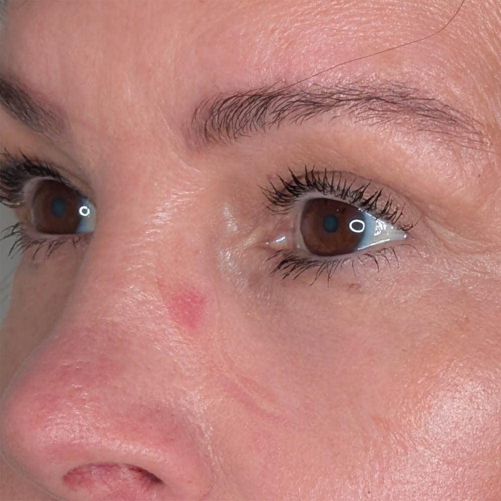 Brow Lift case #5782