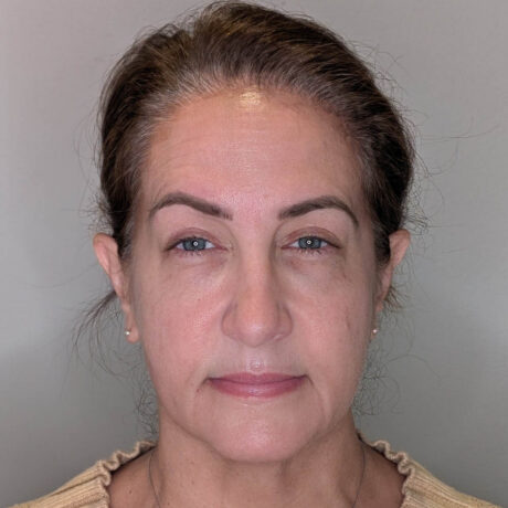 Brow Lift case #5785