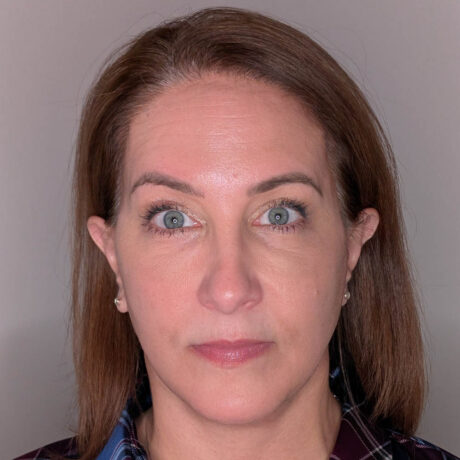 Brow Lift case #5785