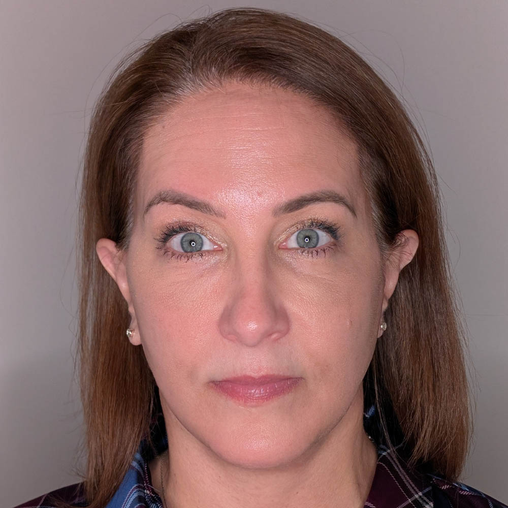 Brow Lift case #5785