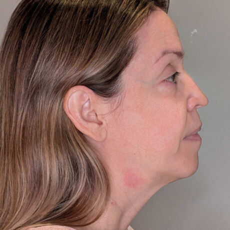 Facelift case #5772