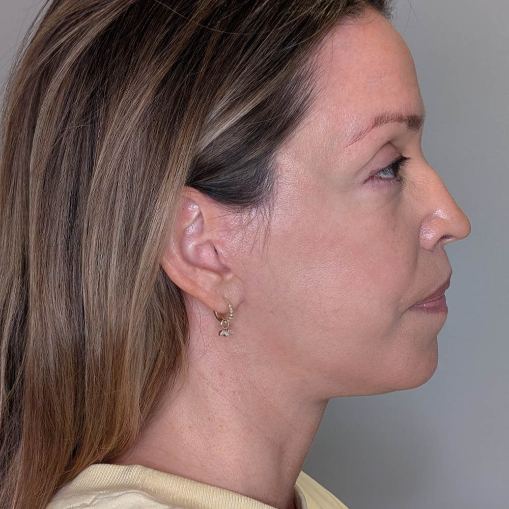 Facelift case #5772