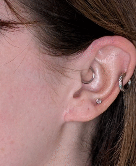 Earlobe Repair & Reduction case #5779