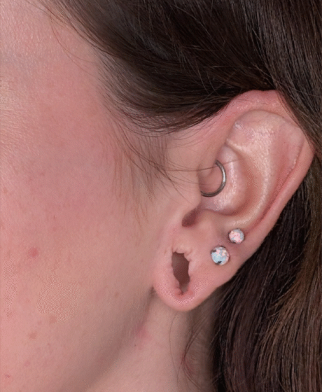 Earlobe Repair & Reduction case #5779