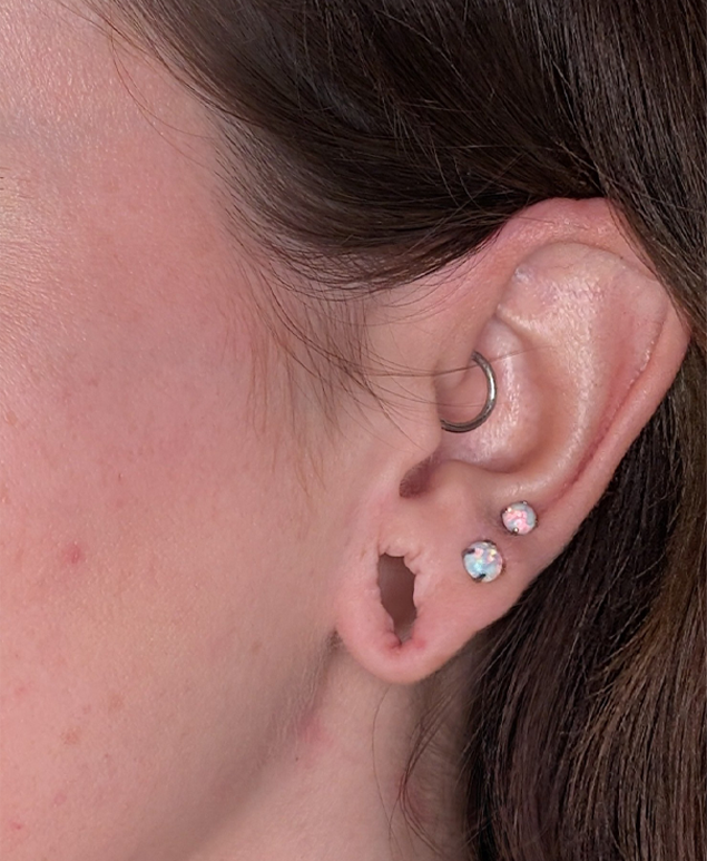 Earlobe Repair & Reduction case #5779