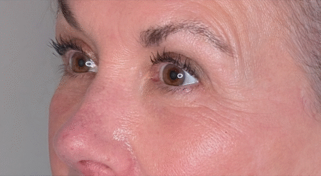 Lower Eyelid Surgery case #5790