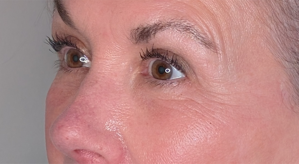 Lower Eyelid Surgery case #5790