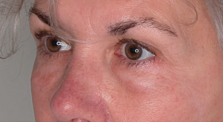 Lower Eyelid Surgery case #5790