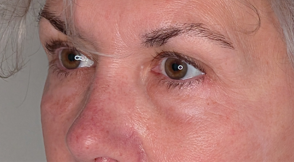 Lower Eyelid Surgery case #5790