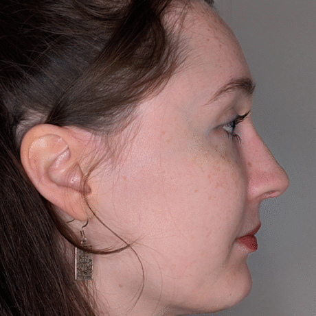 Rhinoplasty case #5796