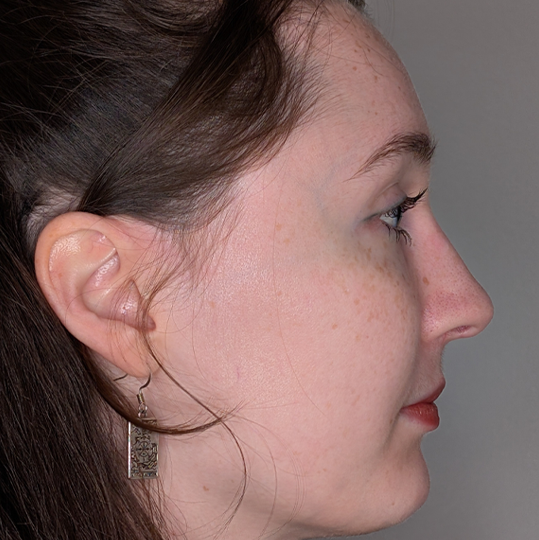 Rhinoplasty case #5796
