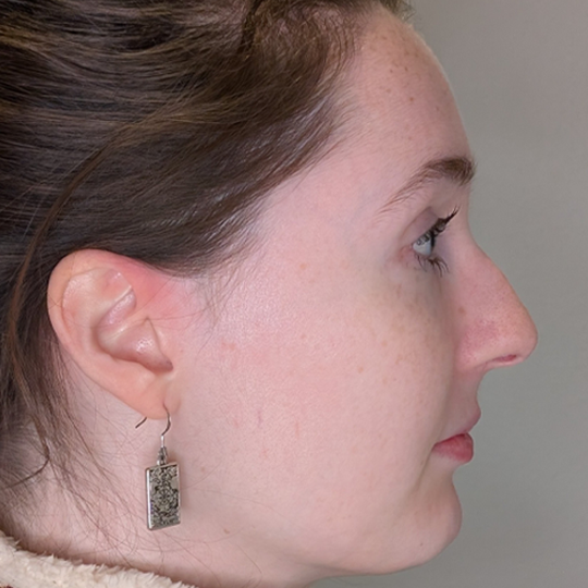 Rhinoplasty case #5796