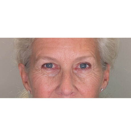 Brow Lift case #5921