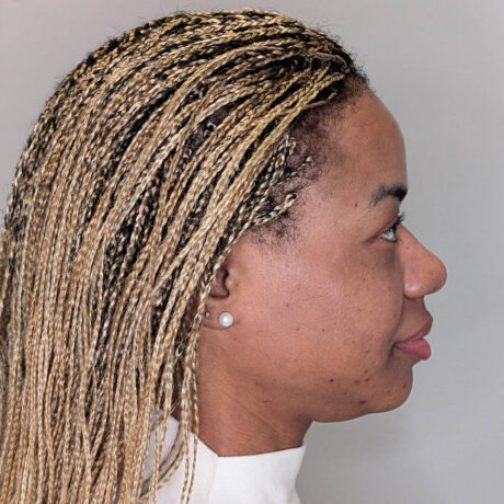 Ponytail Facelift case #5965