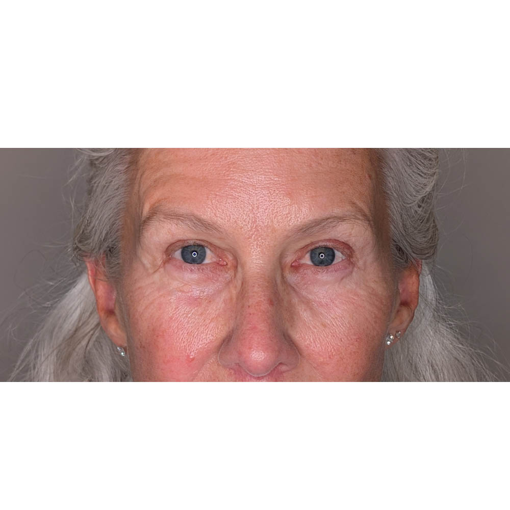 Brow Lift case #5921