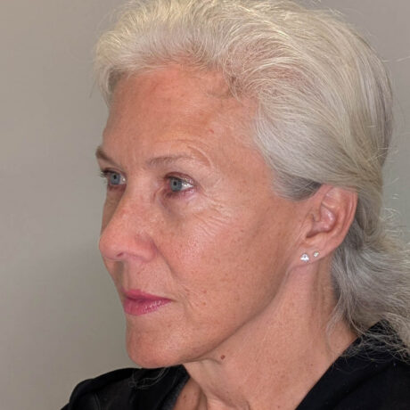 Fat Grafting case #5924