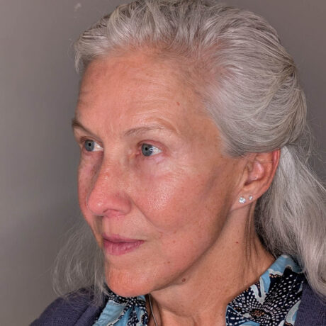 Fat Grafting case #5924