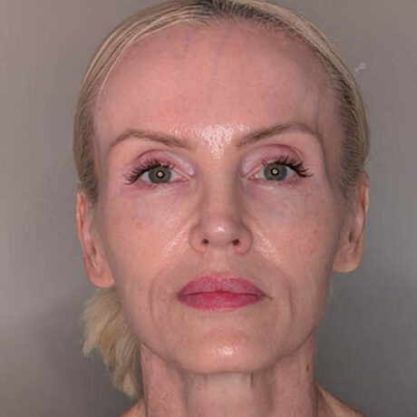 Fat Grafting case #5909