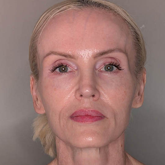 Fat Grafting case #5909