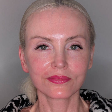 Fat Grafting case #5909