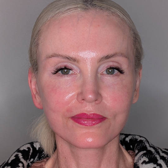 Fat Grafting case #5909